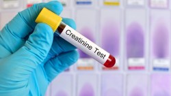 ما هو تحليل creatinine وما أهميته